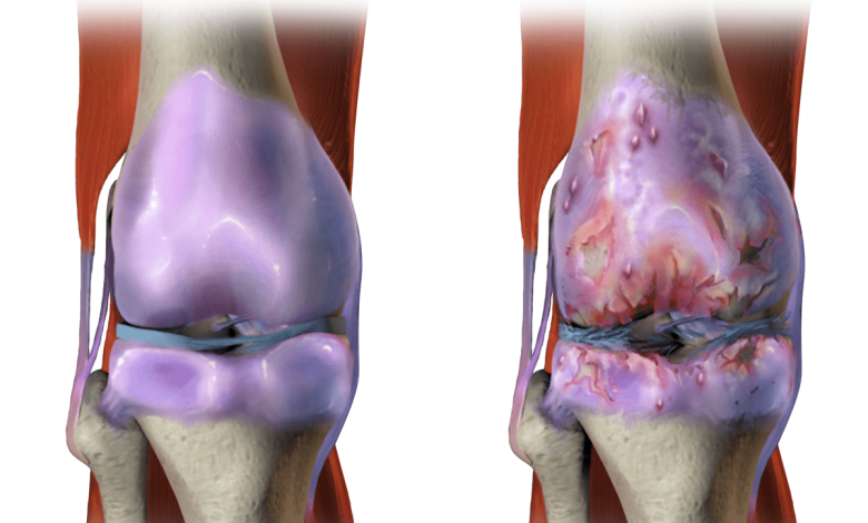 علاج غضروف الركبة بدون جراحة ومدة شفاء غضروف الركبة