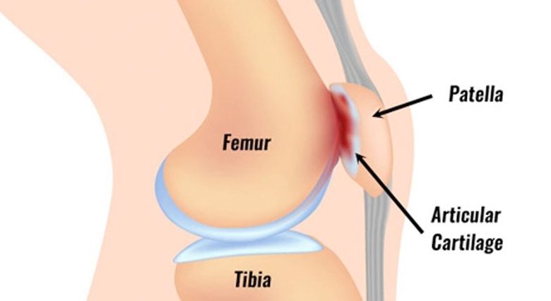 علاج ليونة غضروف صابونة الركبة