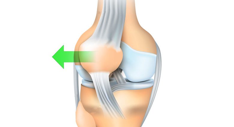 أعراض تحرك صابونة الركبة ومدة علاج خلع صابونة الركبة